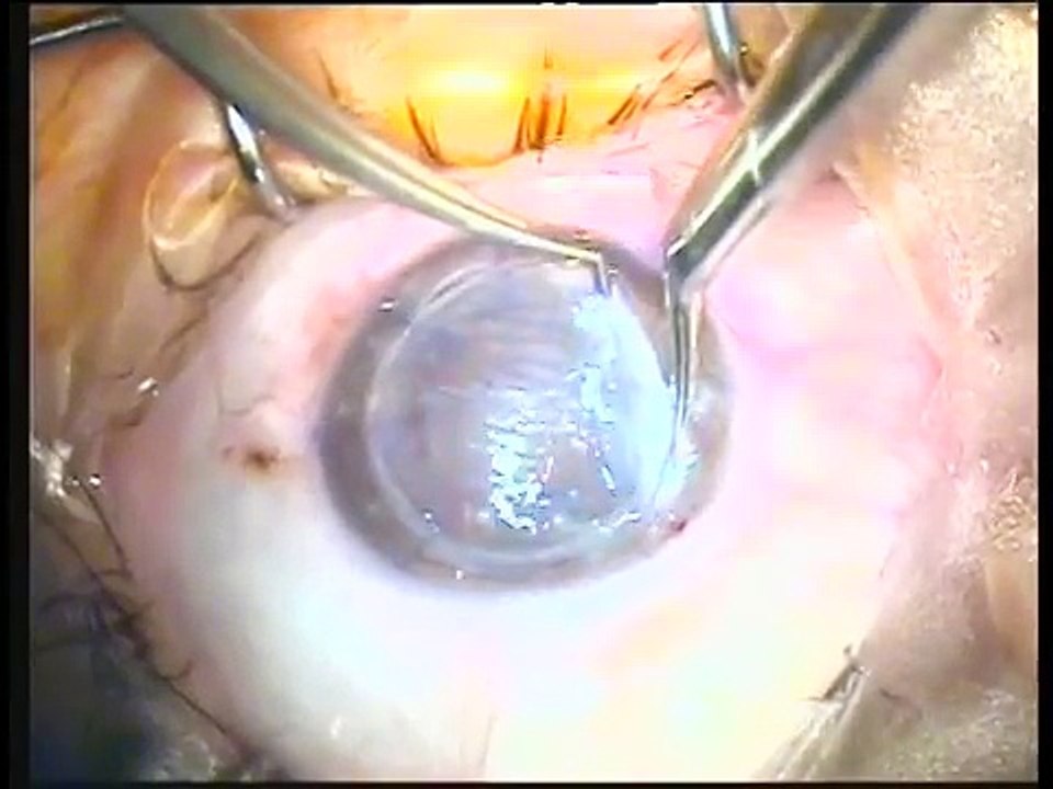 triple procedure