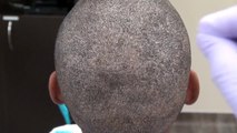 African Man Hair Restoration Surgery Donor Scar FUE Dr. Diep Los Gatos www.mhtaclinic.com