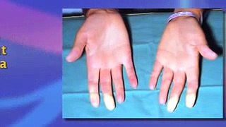 Raynauds' Syndrome