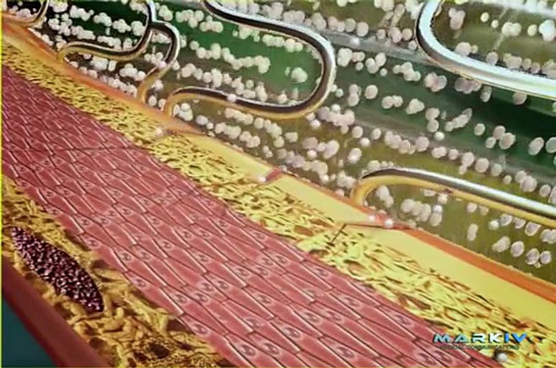 Animation eines Stent Systems