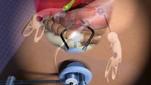 SILS™ Hand Instruments Animation Video