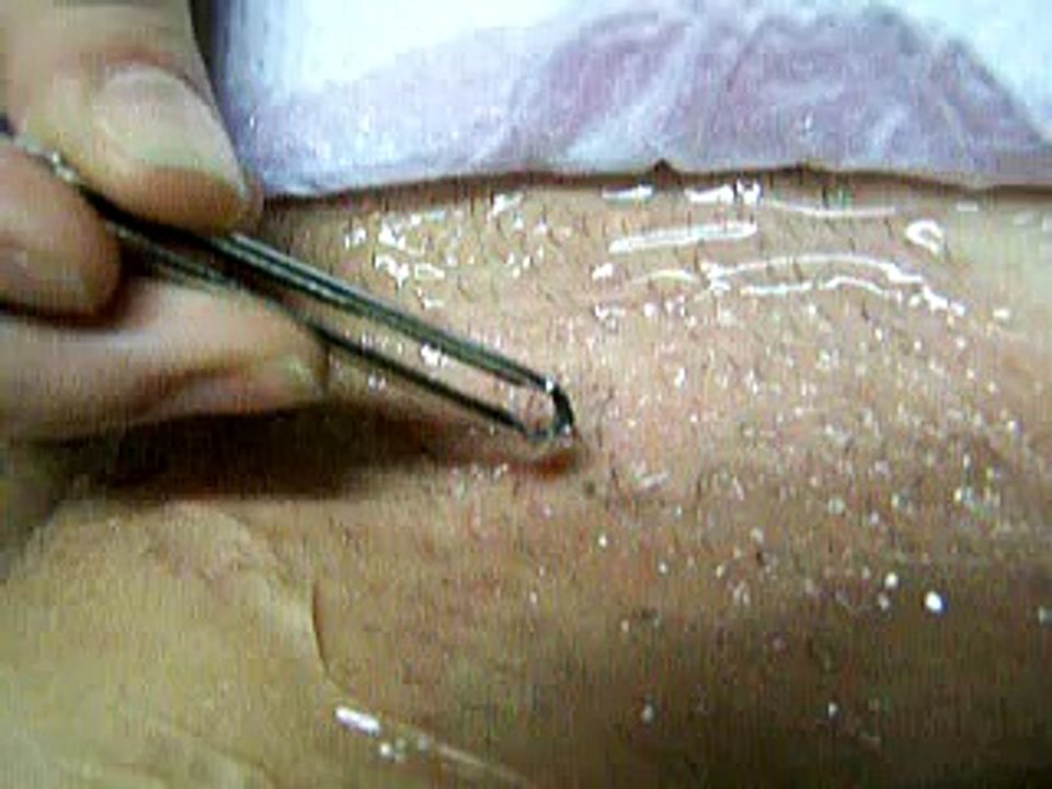 Dr. Paillet, J C Depilación Láser con diodo de barrido - Depilight  Soprano