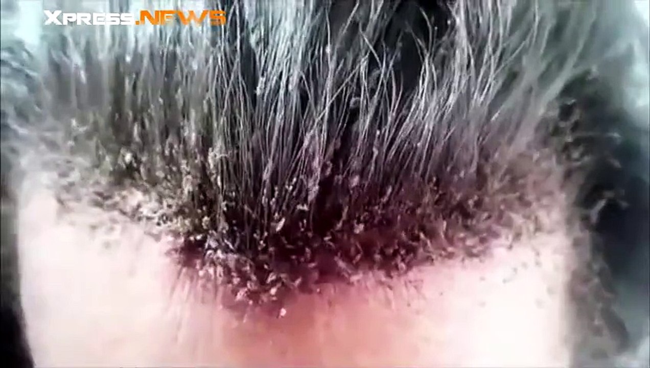 Vous n'avez jamais vu qelqu'un avec autant de poux sur la tête