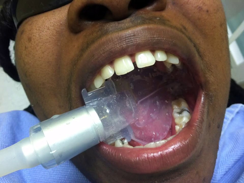 Kona Adapter DS - Attach DryShield Mouthpieces (autoclavable) directly to your HVE valve