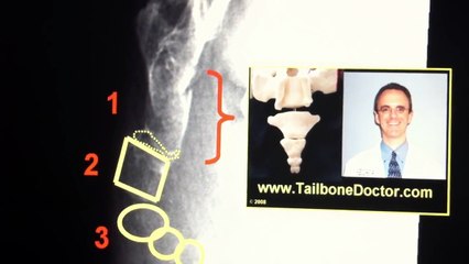 X-rays showing COCCYX FRACTURE (broken tailbone)