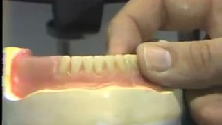 Setting Posterior 0 Versus 0 Degree Artificial Teeth