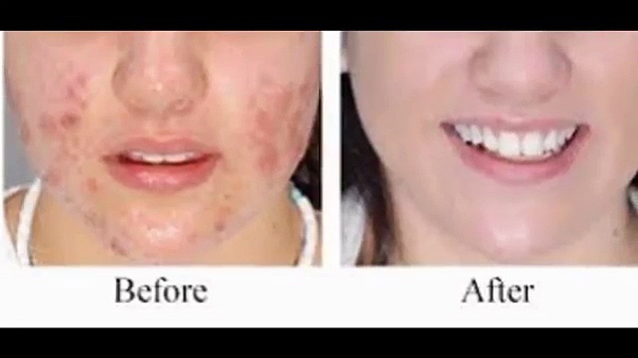 Laser Tattoo Removal in Best Aesthetic Clinic Singapore