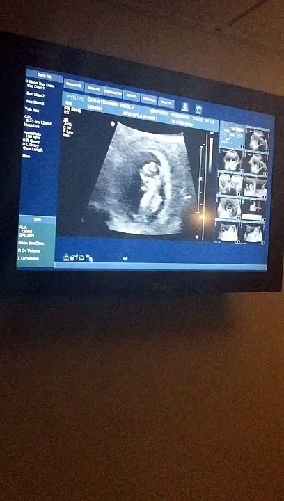 Dancing baby 11 weeks