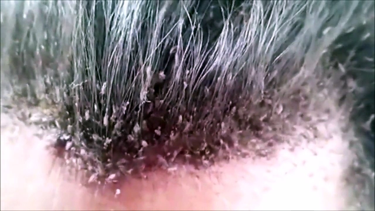 This head lice infestation will make your skin crawl