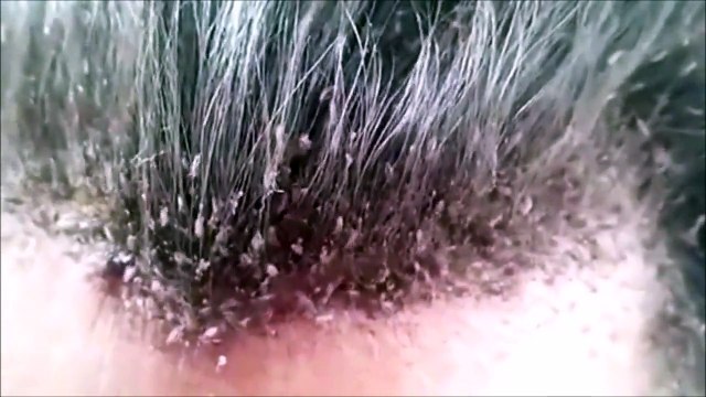 This head lice infestation will make your skin crawl