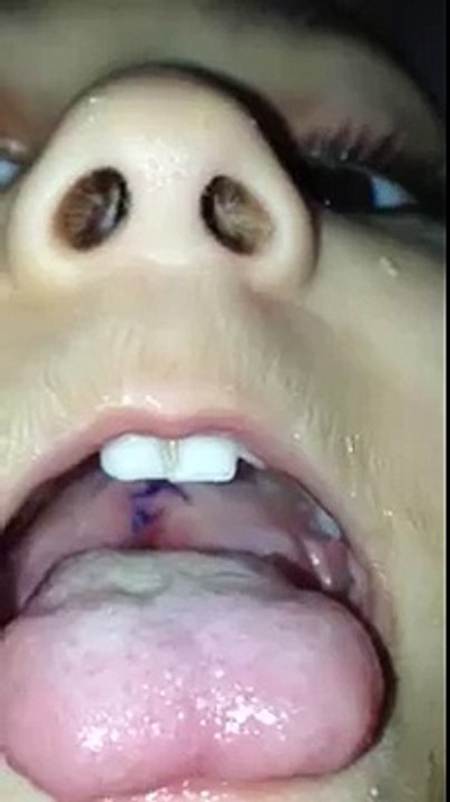 Jehad Al Sukhun Reconstruction of a Cleft Palate-Post Op