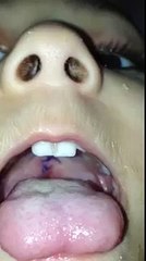 Jehad Al Sukhun Reconstruction of a Cleft Palate-Post Op