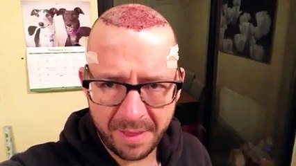 David Patient Journey Hair Transplant - Day 1 - The After ‘Effects'