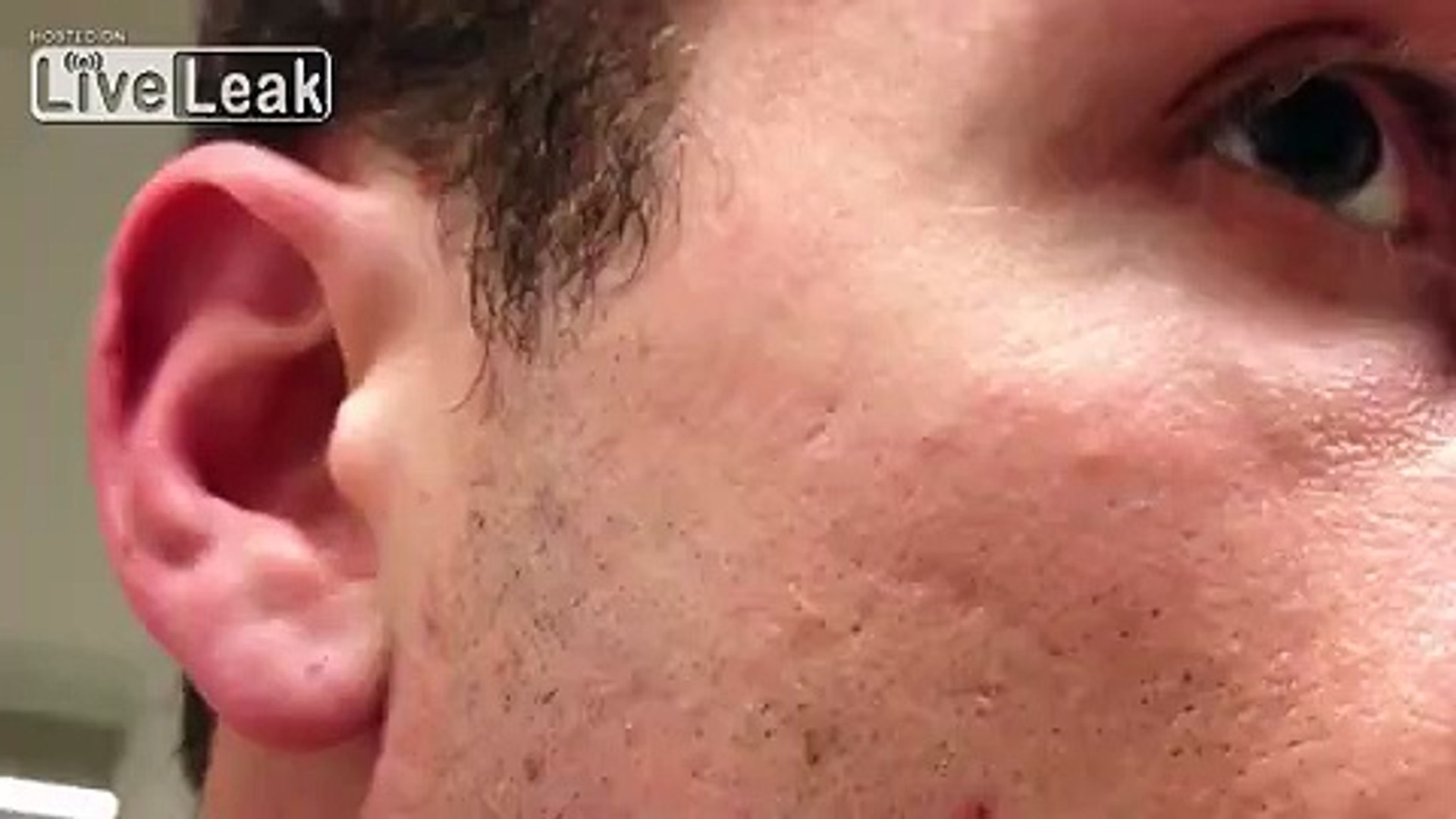 The World S Longest Grossest Ingrowning Hair Video Dailymotion