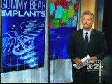 02.Dr. Michael A Fiorillo Explains Gummy Bear Breast Implants o