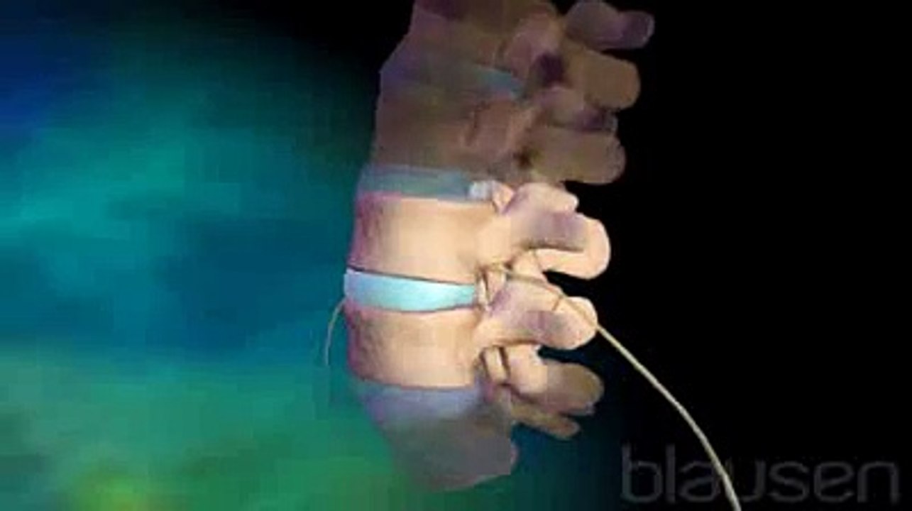 La chirurgie lombaire