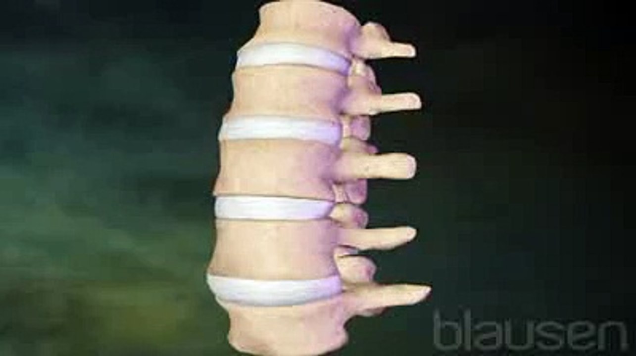 Mal de dos : la lombalgie