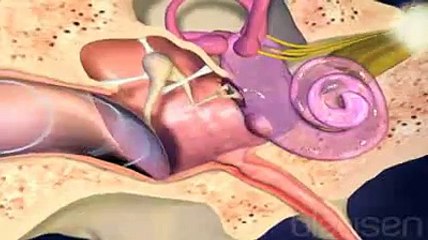 Audition : la pose d'un implant cochléaire