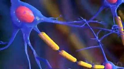 La sclérose en plaques