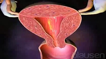 Le cancer de l'utérus