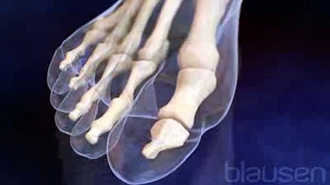 L'hallux valgus - Oignons des pieds