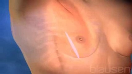 L'augmentation mammaire