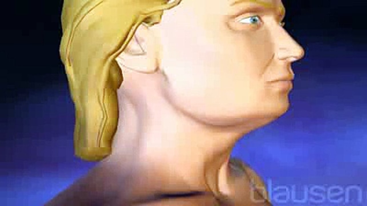 La liposuccion du menton