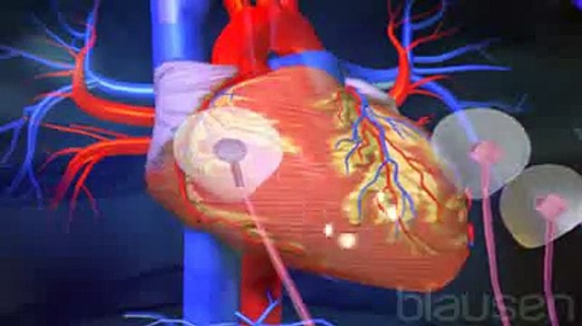 ECG d'effort - Test d'effort