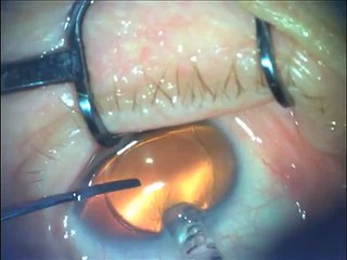 Changer la couleur de ses yeux grâce à des implants en silicone
