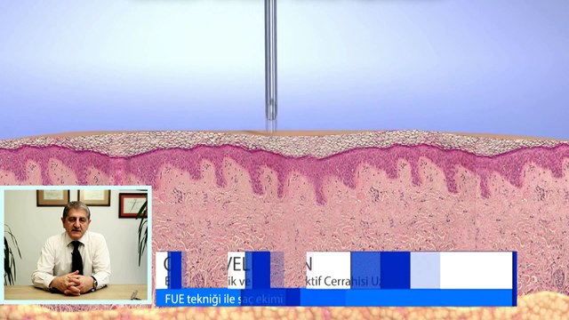 Op. Dr. Veli Aslan - FUE Tekniği ile Saç Ekimi