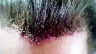The worst head lice video in the world (we have warned you!)