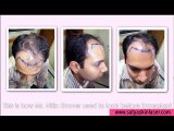 Hair Transplant at Affordable Cost in New Delhi | Hair Expert In India