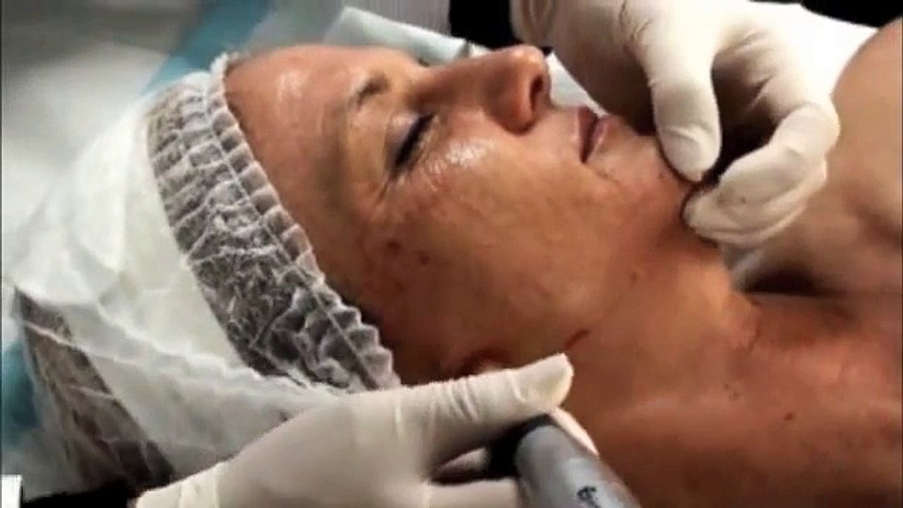Dermapen Product Step by Step Training Video