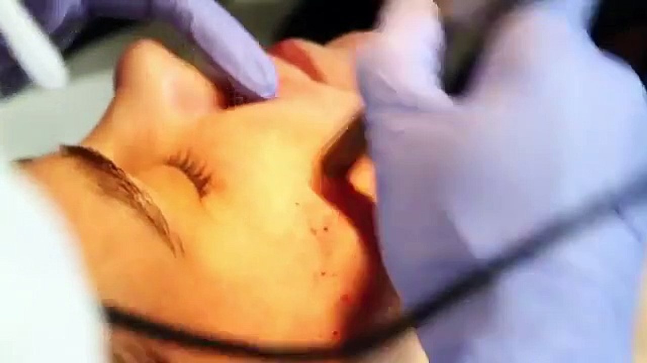 Dermapen Poland - Clinica Dermea features Dermapen Microneedling Treatment