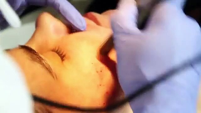 Dermapen Poland - Clinica Dermea features Dermapen Microneedling Treatment