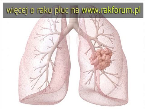 Dieu tri ung thu dai truc trang