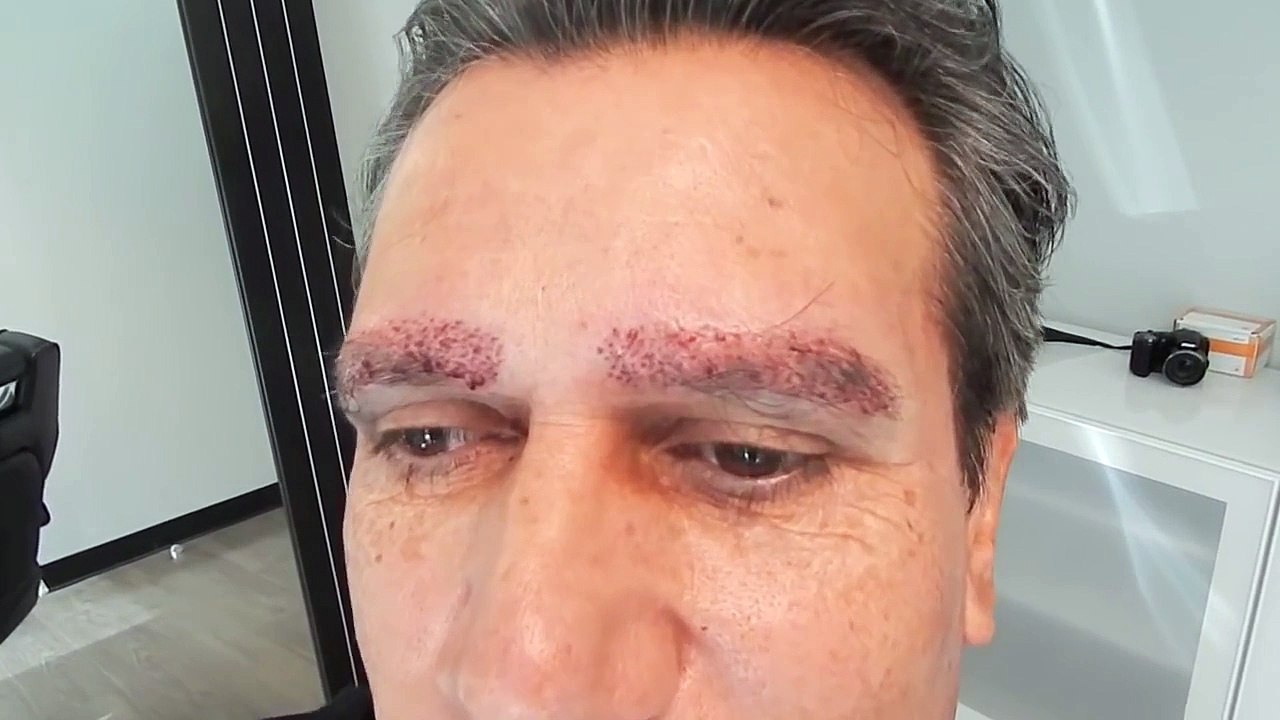Eyebrow Transplant Surgery - best hair replacement
