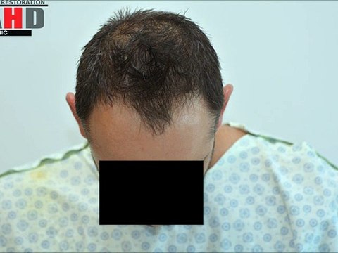 Dr Hakan Doganay Review 3000 grafts, FUE hair transplant forum, hair transplant turkey