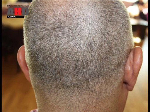 Dr Hakan Doganay Result, hair transplant forum, hair transplant turkey, hair transplant surgery FUE