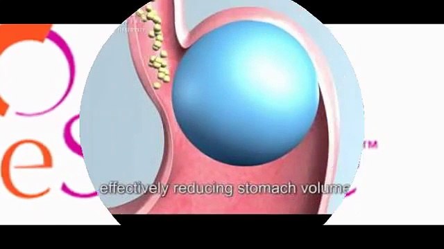 intragastric dual gastric balloon