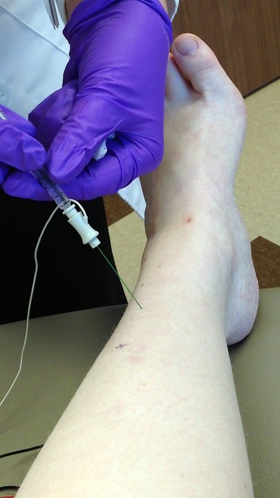 Botox Injection for Contractures