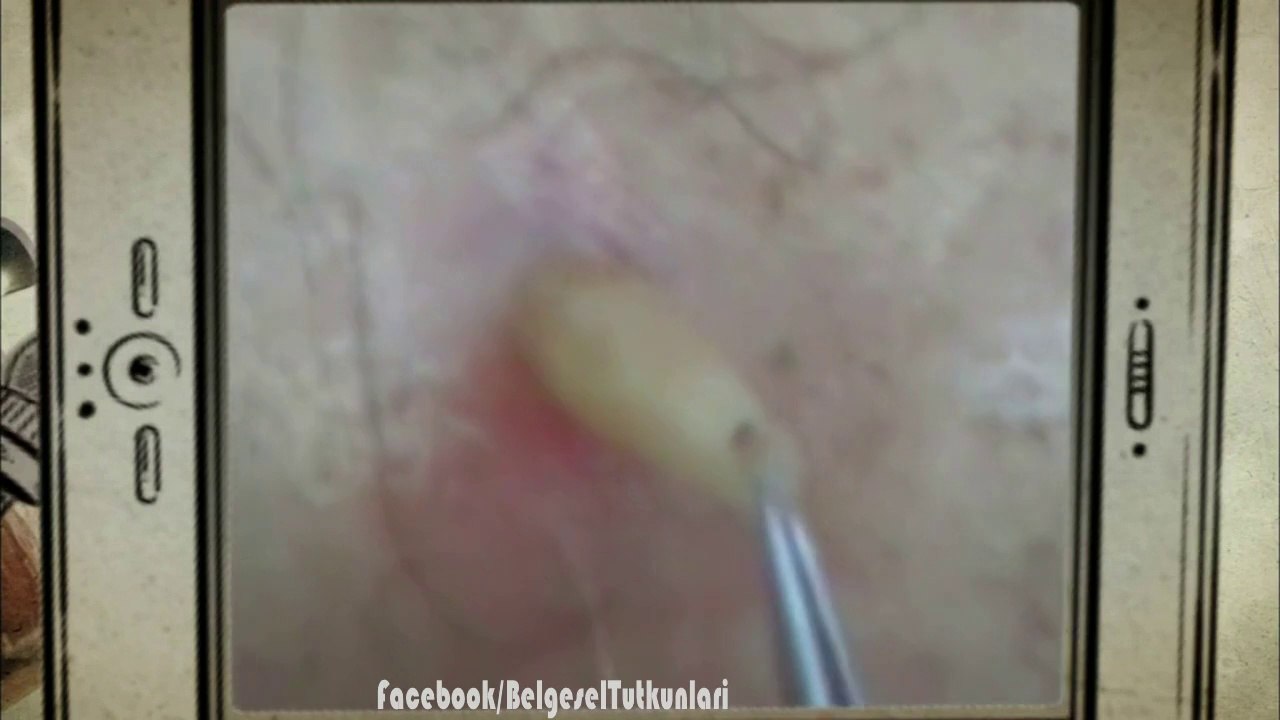 Dünyanın En İğrenç Sineği - Botfly