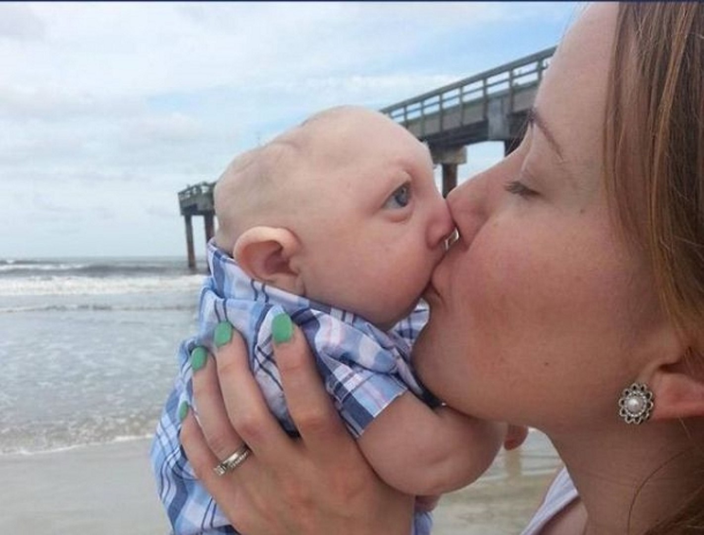Jaxon Emmett Buell Le Bebe Avec Une Grave Malformation Vient De Feter Son Premier Anniversaire Video Dailymotion