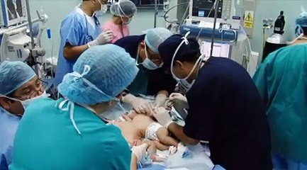 Des jumelles décollées partagent un même rein