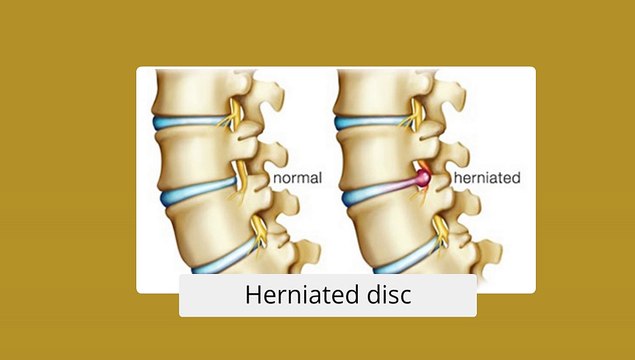 Minimally Invasive Spine Surgery