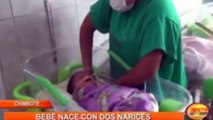 El bebe que nació con dos narices en Perú