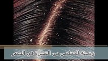 وصفة للتخلص من القشرة في الشعر