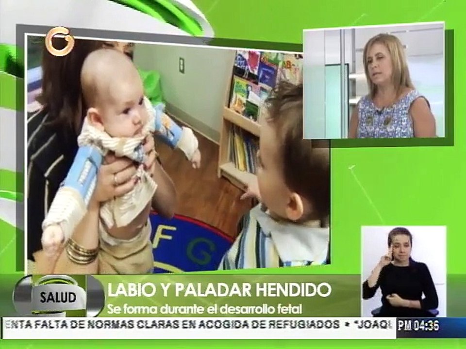 Labio y paladar hendido se dan por desnutrición durante el embarazo