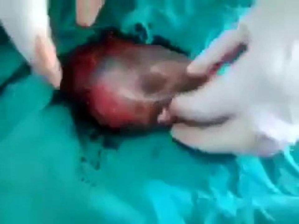 The Supreme court and Planned Parenthood lied to you, it's a baby! Even at 15 Weeks!!