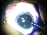 Refractive surgery Services